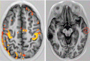 Brain metastases cause severe brain damage that can be inhibited by treatment