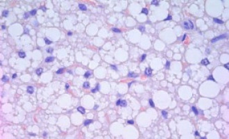 Renegade fat cells induce bone-damaging lesions in multiple myeloma