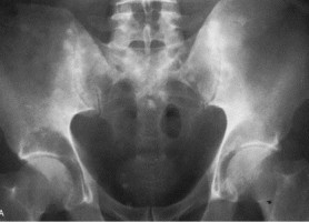 Update on prostate cancer in black men within the UK - ecancer
