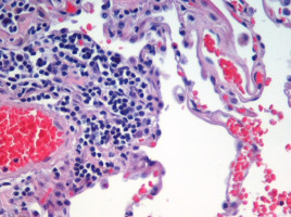 Two therapeutic targets identified for deadly lung cancer