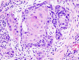 Assessment of circularised E7 RNA, GLUT1, and PD-L1 in anal squamous cell carcinoma