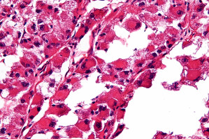 Chemotherapy is used to treat less than 25% of people with localised sarcoma