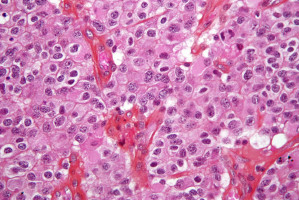 Glioblastoma cholesterol consumption may be a metabolic target.