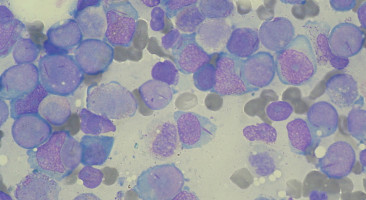 Combination chemotherapy and immunotherapy effective in Phase II leukaemia study