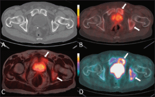 The clinical role of multimodality imaging in the detection of prostate ...