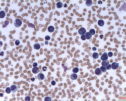 New biomarkers for acute myeloid leukaemia