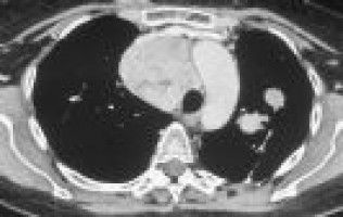 Gemcitabine-induced progressive and sustained tumour response  in a patient with multi-drug resistant uterine leiomyosarcoma - resized_fig2a.JPG