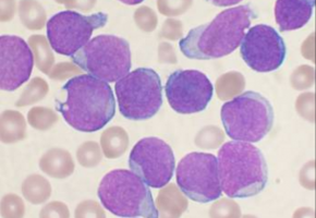 Study reveals properties of cells fated to relapse in acute lymphoblastic leukaemia