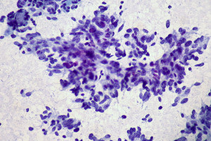 Study offers new insights into why ex-smokers remain at elevated risk of lung disease
