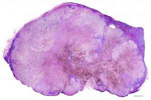 Researchers document how melanoma tumours form