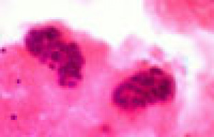Scientists find blood-based biomarkers for inflammatory breast cancer