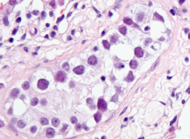 Unique genomic features in testicular cancer ID'd