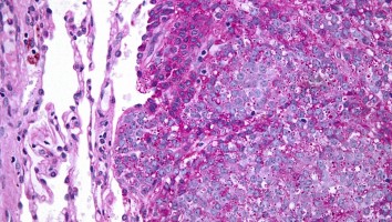 Link between BRCA1 and Ewing sarcoma found