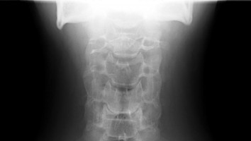 Radioactive bone cement found to be safer in treating spinal tumours