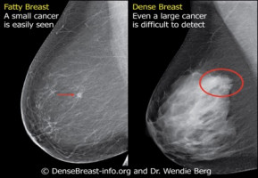 What you should know about breast density and why it matters