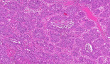 AI model developed by Dresden research team simultaneously detects multiple genetic colorectal cancer markers in tissue samples
