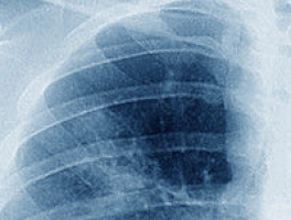 Genetic polymorphism associated with lung cancer progression