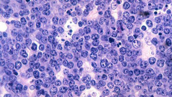 NICE recommends brentuximab vedotin, in combination with chemotherapy, as frontline treatment for a rare type of lymphoma