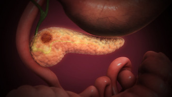 Study offers insights into how pancreatic cancer develops