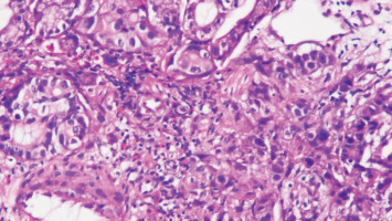 Study validates pyrvinium as treatment to prevent stomach cancer