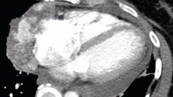 Socioeconomic challenges colour patients’ lung cancer screening experience