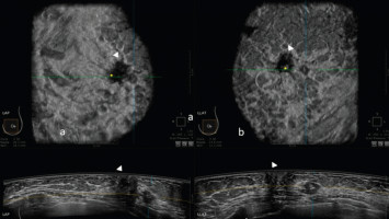 Basics of Breast Ultrasound - Radiology