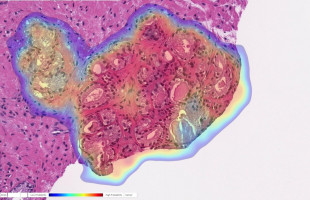 Los investigadores obtienen nuevos conocimientos sobre el cáncer de próstata metastásico