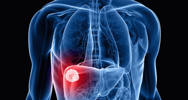 Identification of a novel potential biomarker for hepatocellular carcinoma