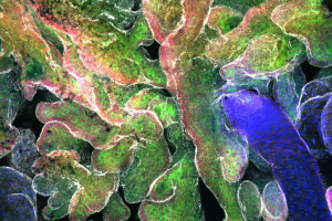 A new cellular model reveals which mutations drive progression to myelodysplastic syndrome and leukaemia in patients with GATA2 deficiency