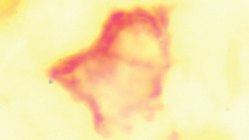 Targeted protein degradation: Researchers find new way to combat harmful proteins in tumour cells