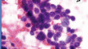 Researchers find new strategy to help immune system fight pancreatic cancer