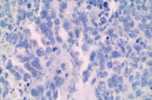 Scientists uncover how ovarian cancer resists chemotherapy — and how to reverse it