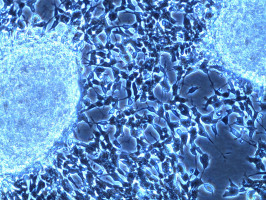 Wider surgical margins may not mean better cancer control, finds large-scale treatment trial