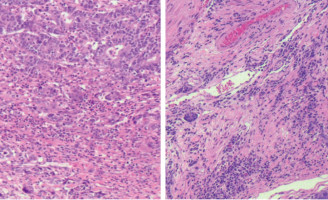 Tumour-infiltrating lymphocyte therapy offers a promising approach for treating solid tumours