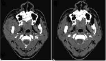 New study sheds light on evolving trends in oral cavity cancer among younger adults