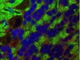 Un tipo de célula oculta relacionada con el VPH podría provocar cáncer de cuello uterino en fase inicial