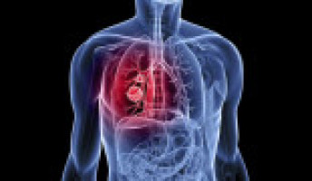 Research suggests early heart changes may predict future cancer risk