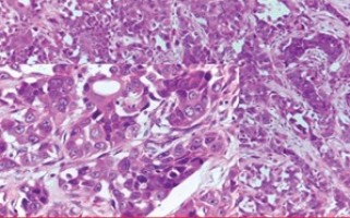 ASCO GU 2026: Cancer’s clues in the bloodstream reveal the role androgen receptor alterations play in metastatic prostate cancer