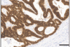 Risk factors of anastomotic leak in colorectal cancer: a ...