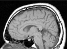 La radiación después de la cirugía triplica la supervivencia de un tipo de tumor cerebral pediátrico