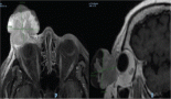 Bulky palpebral Merkel cell carcinoma of the eyelid