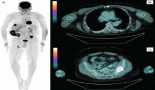 Immunotherapy and local therapies in metastatic laryngeal cancer management: a case report