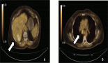 Atezolizumab-induced neuromuscular syndrome mimicking myasthenia gravis in a patient with hepatocellular carcinoma – an area of concern