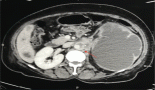 Vanishing clear cell carcinoma of the kidney presenting with skin metastases – a case report
