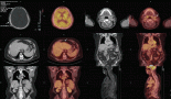 Beyond the liver: a case of solitary skull lesion with hepatocellular features without a primary malignancy