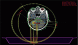 Encountering the unicorn – abscopal effect after fractionated stereotactic radiosurgery for brain metastasis in renal cell carcinoma: a case report and review of the literature