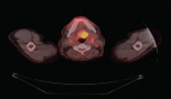A rare case of clear cell Hidradenocarcinoma presenting with recurrent pleural and cardiac effusion