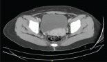 Lymphoepithelioma epidermoid carcinoma of the uterine cervix: surgical management of an isolated case and review of the literature