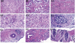 Assessment of mismatch repair proteins (MLH1 and MSH2) and p53 immunohistochemical expression in prostatic carcinoma: association with different clinicopathologic characteristics