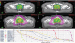Feasibility and impact of knowledge-based automated radiotherapy treatment planning in low- and middle-income countries